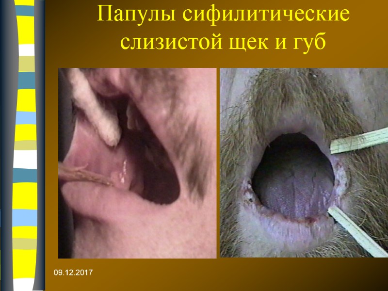 09.12.2017 Папулы сифилитические слизистой щек и губ